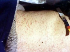 中醫(yī)望皮膚之頸部癤子