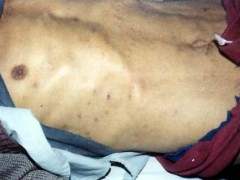 中醫(yī)望皮膚之腹部凹陷、帶狀皰疹