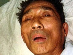 中醫(yī)望神之無神(昏迷)