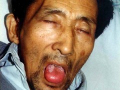 中醫望色之惡色(面色黧黑，舌紅腫脹)